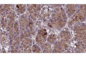 ABIN6273984 at 1/100 staining Human liver cancer tissue by IHC-P. (OR2V1 antibody  (Internal Region))