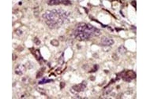IHC analysis of FFPE human breast carcinoma tissue stained with the BTK antibody (BTK antibody  (AA 209-239))