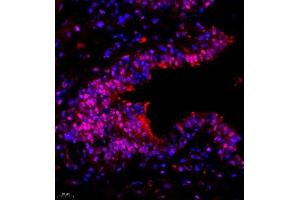 Immunofluorescence of paraffin embedded human breast cancer using SUV39H1 (ABIN7075770) at dilution of 1:1000 (400x lens) (SUV39H1 antibody)