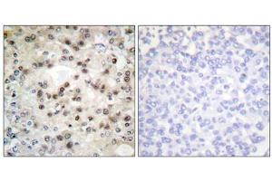 Immunohistochemistry analysis of paraffin-embedded human breast carcinoma tissue using USF2 antibody.