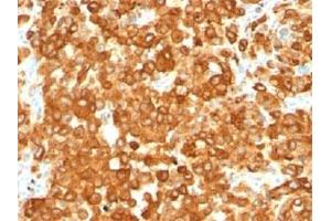 IHC staining of human melanoma with gp100 antibody (HMB45).