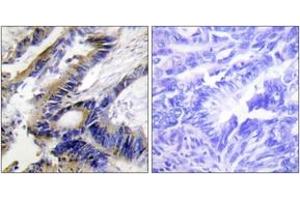 Immunohistochemistry analysis of paraffin-embedded human colon carcinoma tissue, using ILKAP Antibody.