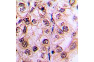 Immunohistochemical analysis of MST1/2 (pT183) staining in human breast cancer formalin fixed paraffin embedded tissue section. (MST1/MST2 (pSer183) antibody)