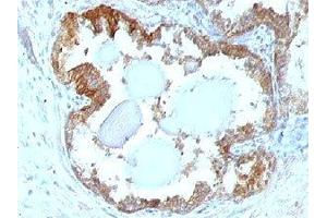 IHC testing of FFPE human prostate carcinoma and HSP27 antibody. (HSP27 antibody)