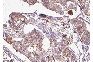 ABIN6267685 at 1/100 staining human Breast cancer tissue sections by IHC-P. (ASK1 antibody  (pSer83))