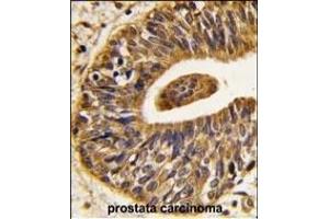 Formalin-fixed and paraffin-embedded human prostata carcinoma tissue reacted with ERBB2 Antibody (C-term ), which was peroxidase-conjugated to the secondary antibody, followed by DAB staining. (ErbB2/Her2 antibody  (C-Term))