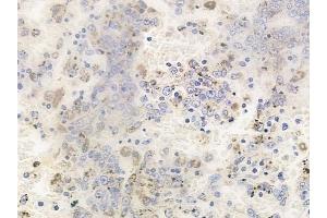 ABIN6256779 and ABIN6267619 at 1/100 staining human melanoma by IHC-P. (PKC delta antibody  (pTyr64))