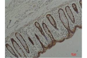 Immunohistochemistry (IHC) analysis of paraffin-embedded Human Colon Carcicnoma using HSP90 alpha Mouse Monoclonal Antibody diluted at 1:200.