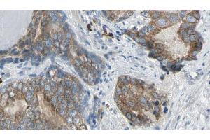 ABIN6269165 at 1/100 staining Human prostate tissue by IHC-P. (Phospholipase C gamma 2 antibody  (Internal Region))