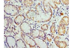 Immunohistochemistry of paraffin-embedded human gastric cancer using ABIN7155429 at dilution of 1: 100 (HIST2H3A antibody  (AA 108-136))
