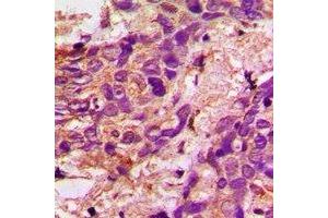Immunohistochemical analysis of Aconitase 1 staining in human prostate cancer formalin fixed paraffin embedded tissue section. (Aconitase 1 antibody  (N-Term))