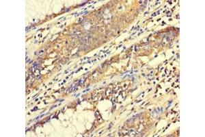 Immunohistochemistry of paraffin-embedded human colon cancer using ABIN7165014 at dilution of 1:100 (ABHD18 antibody  (AA 25-414))