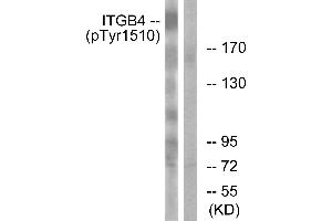 Immunohistochemistry analysis of paraffin-embedded human breast carcinoma tissue using ITGB4 (Phospho-Tyr1510) antibody. (Integrin beta 4 antibody  (pTyr1510))
