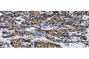 Immunohistochemistry of paraffin-embedded Human prost ate cancer tissue using GANAB Polyclonal Antibody at dilution of 1:30(x200) (GANAB antibody)