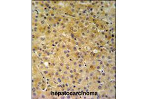NDUFA10 Antibody IHC analysis in formalin fixed and paraffin embedded hepatocarcinoma followed by peroxidase conjugation of the secondary antibody and DAB staining.