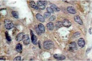Immunohistochemistry (IHC) analyzes of p-c-Src antibody in paraffin-embedded human breast carcinoma tissue. (NCOA1 antibody  (pTyr529))