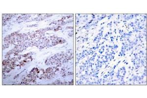 Immunohistochemical analysis of paraffin-embedded human breast carcinoma tissue using ATF4(Phospho-Ser245) Antibody(left) or the same antibody preincubated with blocking peptide(right). (ATF4 antibody  (pSer245))