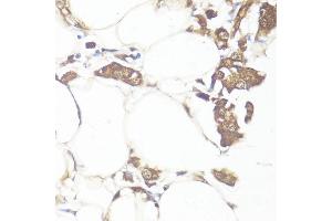 Immunohistochemistry of paraffin-embedded human breast cancer using Smad7 antibody (ABIN7270356) at dilution of 1:100 (40x lens). (SMAD7 antibody  (AA 1-100))