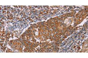 Immunohistochemistry of paraffin-embedded Human cervical cancer tissue using PMPCB Polyclonal Antibody at dilution 1:50 (PMPCB antibody)