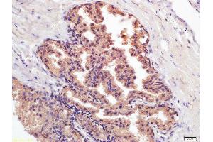 Formalin-fixed and paraffin embedded human prostate carcinoma labeled with Mouse Anti-PSA (PA5) Monoclonal Antibody, Unconjugated (bsm-1626M) at 1:200 followed by conjugation to the secondary antibody and DAB staining (Prostate Specific Antigen antibody)