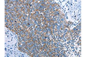 The image on the left is immunohistochemistry of paraffin-embedded Human cervical cancer tissue using ABIN7129698(HINT2 Antibody) at dilution 1/40, on the right is treated with fusion protein.