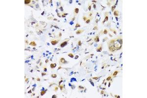 Immunohistochemistry of paraffin-embedded human lung cancer using EP300 antibody (ABIN6127823, ABIN6140193, ABIN6140194 and ABIN6216844) at dilution of 1:100 (40x lens). (p300 antibody  (AA 1-270))