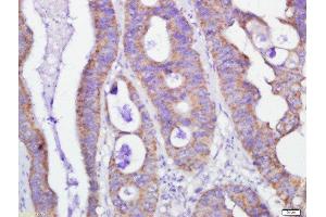 Paraformaldehyde-fixed, paraffin embedded human colon cancer, Antigen retrieval by boiling in sodium citrate buffer (pH6) for 15min, Block endogenous peroxidase by 3% hydrogen peroxide for 30 minutes, Blocking buffer (normal goat serum) at 37°C for 20min, Antibody incubation with GRP75 Polyclonal Antibody, Unconjugated  at 1:500 overnight at 4°C, followed by a conjugated secondary and DAB staining. (HSPA9 antibody  (AA 561-679))