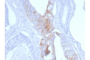 Formalin-fixed, paraffin-embedded human Colon Carcinoma stained with Cytokeratin 20 Mouse Monoclonal Antibody (KRT20/3145). (KRT20 antibody  (AA 196-323))