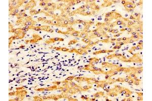 IHC image of ABIN7170921 diluted at 1:400 and staining in paraffin-embedded human liver cancer performed on a Leica BondTM system.