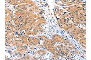 The image on the left is immunohistochemistry of paraffin-embedded Human lung cancer tissue using ABIN7128174(ACOX3 Antibody) at dilution 1/25, on the right is treated with fusion protein.