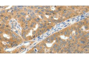 Immunohistochemistry of paraffin-embedded Human ovarian cancer tissue using SCN9A Polyclonal Antibody at dilution 1:40 (SCN9A antibody)