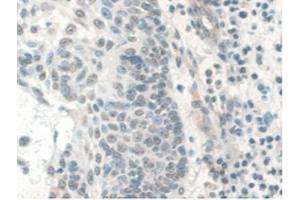 IHC-P analysis of Human Skin Cancer Tissue, with DAB staining. (COQ6 antibody  (AA 1-468))