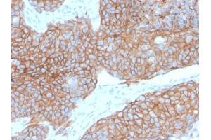 Immunohistochemistry (IHC) image for anti-Cadherin 1, Type 1, E-Cadherin (Epithelial) (CDH1) antibody (ABIN6941299)