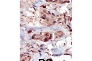 Formalin-fixed and paraffin-embedded human cancer tissue reacted with the primary antibody, which was peroxidase-conjugated to the secondary antibody, followed by AEC staining. (SPHK2 antibody  (C-Term))