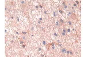 DAB staining on IHC-P; Samples: Human Glioma Tissue (PTH1R antibody  (AA 28-188))