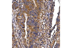 Immunohistochemistry of paraffin-embedded human colon carcinoma using DYNC1LI2 Rabbit pAb (ABIN7266863) at dilution of 1:25 (40x lens). (DYNC1LI2 antibody)