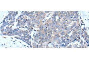 Immunohistochemistry of paraffin-embedded Human thyroid cancer tissue using VPS35 Polyclonal Antibody at dilution of 1:25(x200) (VPS35 antibody)