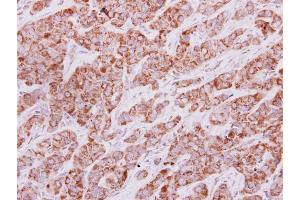 IHC-P Image IDH3G antibody detects IDH3G protein at cytoplasm on human lung carcinoma by immunohistochemical analysis.