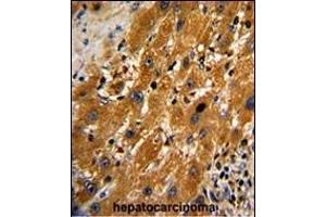 Formalin-fixed and paraffin-embedded human hepatocarcinoma with CASP9 Antibody , which was peroxidase-conjugated to the secondary antibody, followed by DAB staining. (Caspase 9 antibody  (Ser196))