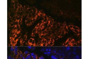 Immunofluorescence analysis of Human lung cancer cells using SCNN1A Polyclonal Antibody at dilution of 1:100. (SCNN1A antibody)