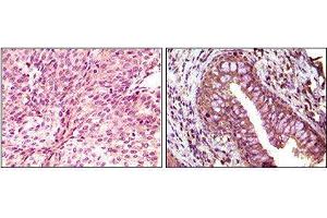 Immunohistochemical analysis of paraffin-embedded human bladder carcinoma (left) and return carcinoma (right) tissue, showing cytoplasmic localization using EphB6 mouse mAb with DAB staining. (EPH Receptor B6 antibody)