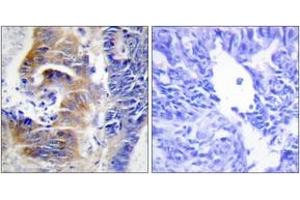 Immunohistochemistry analysis of paraffin-embedded human colon carcinoma tissue, using CDCA3 Antibody. (CDCA3 antibody  (AA 219-268))