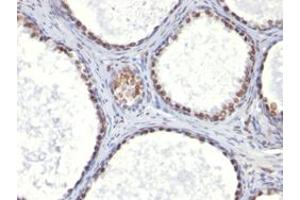 Immunohistochemical staining (Formalin-fixed paraffin-embedded sections) of human prostate cancer with AR monoclonal antibody, clone AR441 . (Androgen Receptor antibody  (AA 300-316))