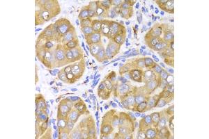 Immunohistochemistry of paraffin-embedded human liver cancer using LRPAP1 Antibody (ABIN5971543) at dilution of 1/100 (40x lens). (LRPAP1 antibody)