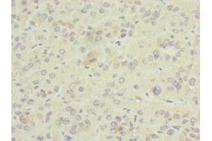 Immunohistochemistry of paraffin-embedded human liver cancer using ABIN7153581 at dilution of 1:100 (GDAP1 antibody  (AA 1-225))