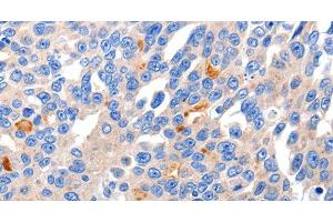 Immunohistochemistry of paraffin-embedded Human liver cancer tissue using KCNH8 Polyclonal Antibody at dilution 1:50