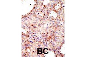 Formalin-fixed and paraffin-embedded human cancer tissue reacted with ARFGAP1 polyclonal antibody  , which was peroxidase-conjugated to the secondary antibody, followed by AEC staining .