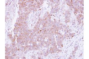 IHC-P Image Immunohistochemical analysis of paraffin-embedded human lung Papillary adenocarcinoma, using CD81, antibody at 1:250 dilution. (CD81 antibody)