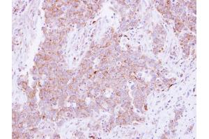 IHC-P Image Immunohistochemical analysis of paraffin-embedded human lung Papillary adenocarcinoma, using CD81, antibody at 1:250 dilution.