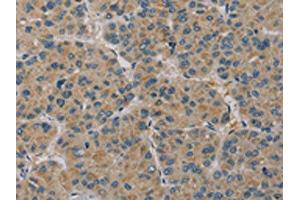 The image on the left is immunohistochemistry of paraffin-embedded Human liver cancer tissue using ABIN7130528(PAGE2 Antibody) at dilution 1/20, on the right is treated with fusion protein. (PAGE2 antibody)